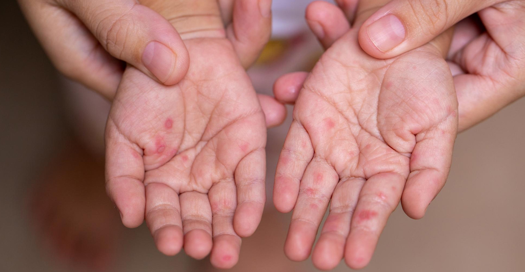 Hand Foot and Mouth Disease